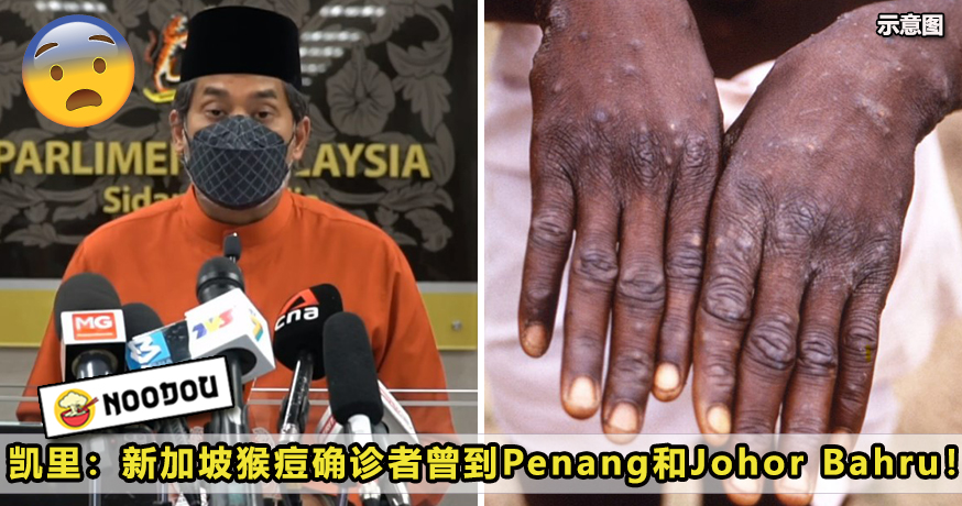 monkeypox ft