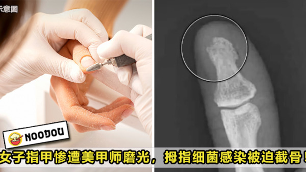 Manicure Over Infected Feature Image