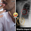 25th Annicersary Lung Cancer Smoke Feature Img